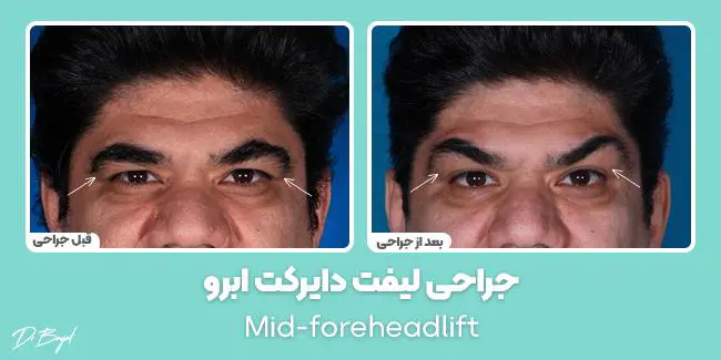 جراحه رفع الحاجب المباشر