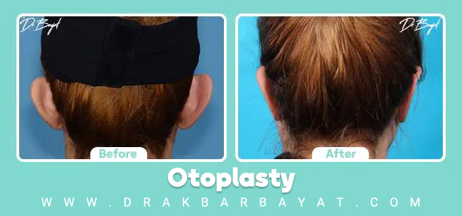 تجميل الأذن