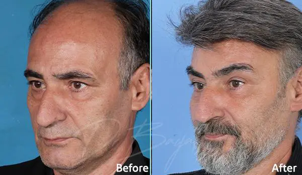 رفع الحاجب