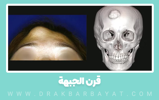 قرن الجبهة (Forehead Horn)​