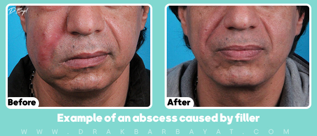 مضاعفات فيلرات الجيل