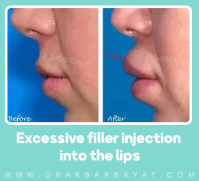 حجم الشفاه بالإضافة