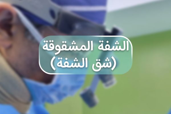 الشفة المشقوقة