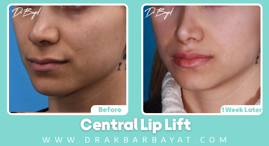 Central Lip Lift