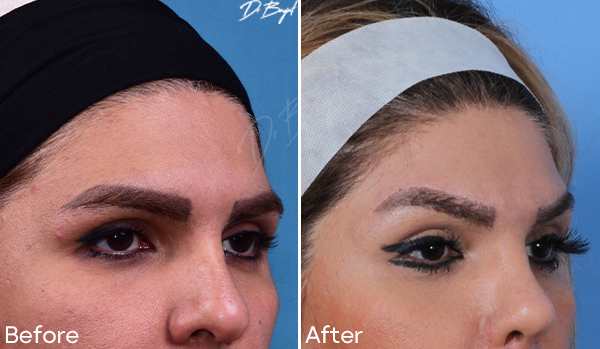 Direct Eyebrow Lift
