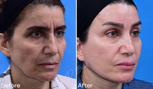 Facelift Surgery​
