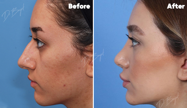 Rhinoplasty