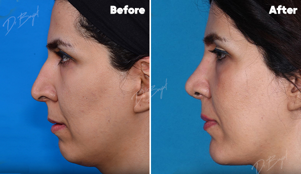 Rhinoplasty