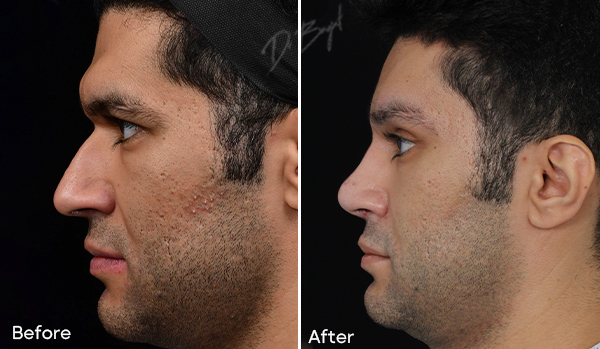Rhinoplasty