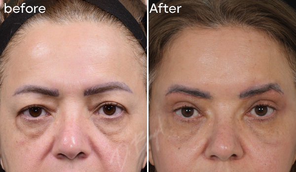Sub Brow Lift