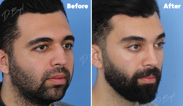Rhinoplasty
