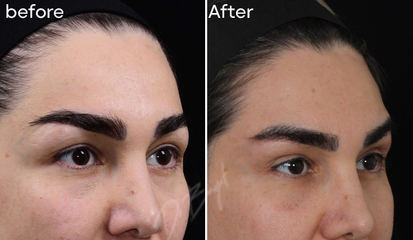 Sub Brow Lift