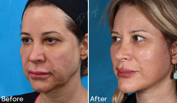 Facelift Surgery​