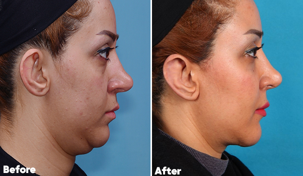 Neck Lift Surgery