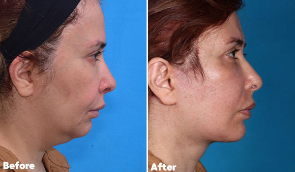Neck Lift Surgery​
