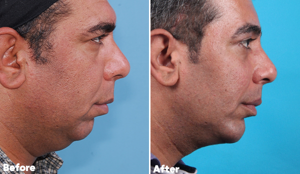 Neck Lift Surgery​