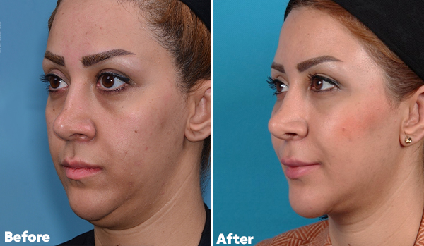 Neck Lift Surgery​