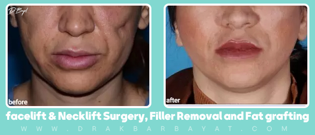 Amount and location of injected gel​