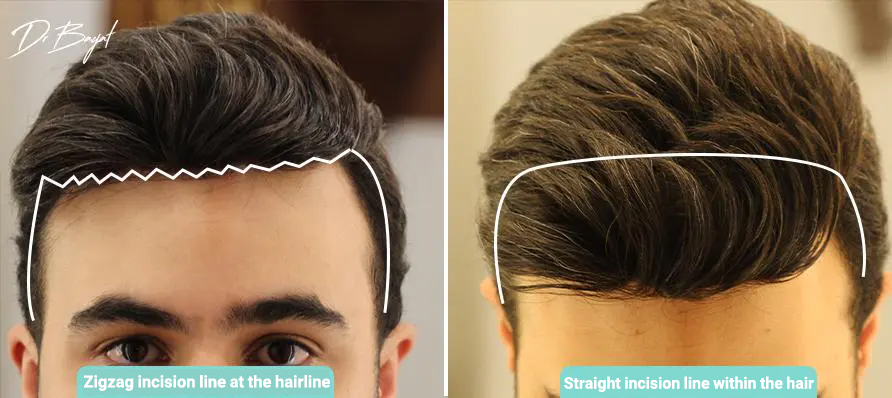 incision for forehead