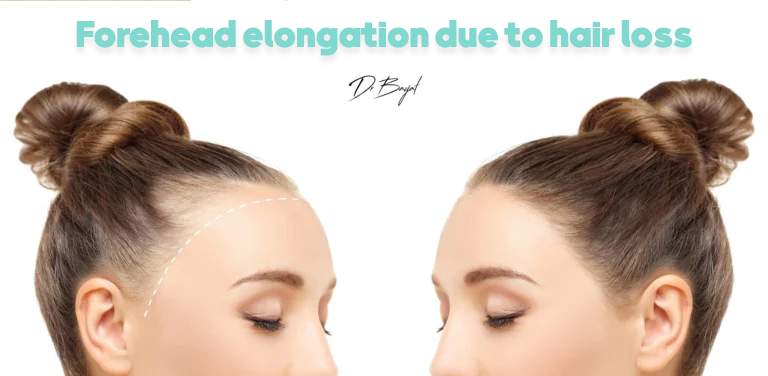 What are the permanent options?​