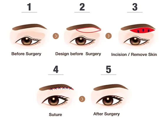 direct brow lift steps