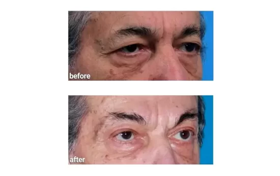 before after Blepharoplasty surgery