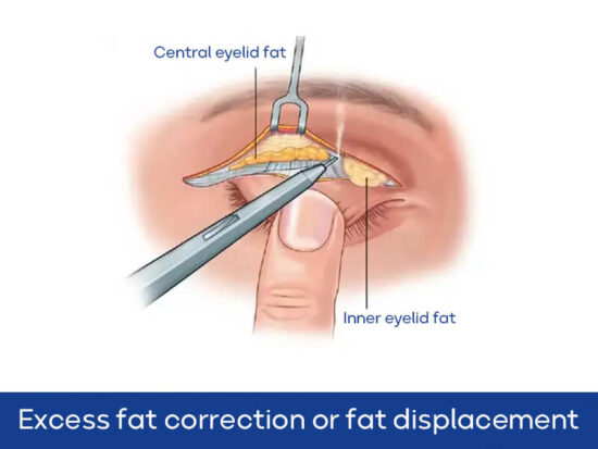 Excess fat correction or fat displacement
