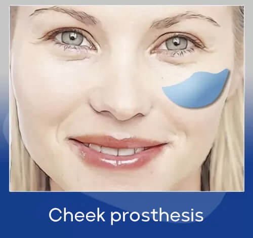 cheek prosthesis