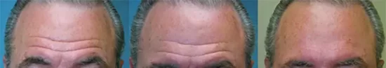 eliminate the deep face wrinkles