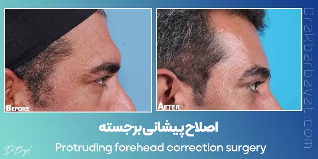 protruded forehead correction surgery
