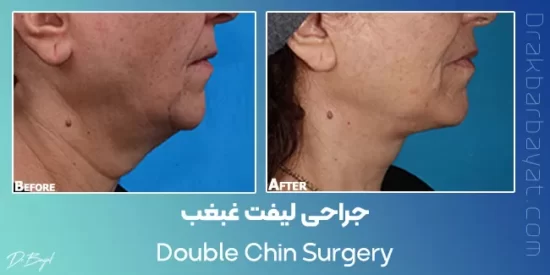 Double chin correction surgery