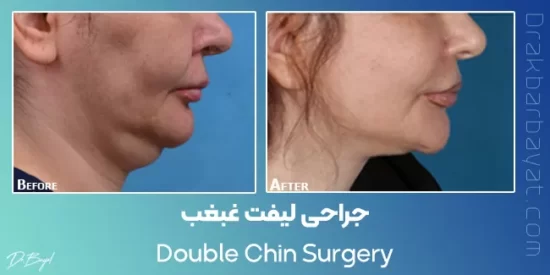 Double chin removal