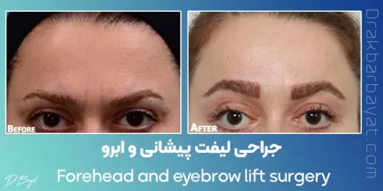 remove Forehead wrinkles and frown line