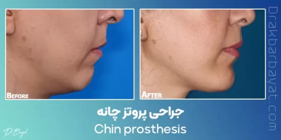chhin prosthesis before after