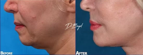 neck cosmetic surgery