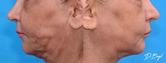 Reduction of fat accumulation under the chin