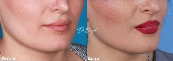 before after dermofat graft