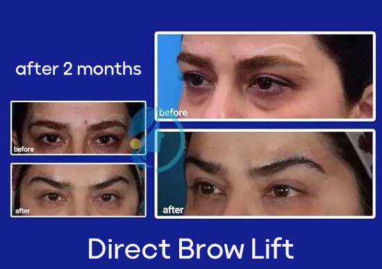best-direct-brow-lift-surgery-in-iran