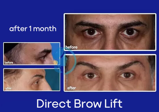 direct-brow-lift-in-iran
