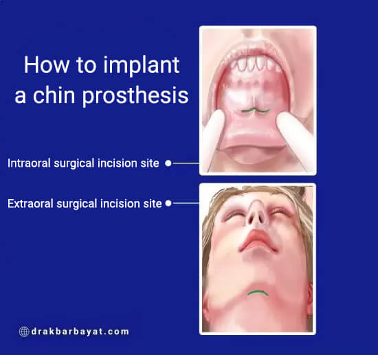 how to implant a chin prosthesis