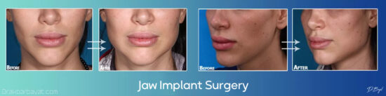 jaw implant surgery