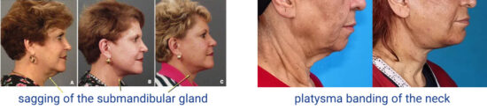 platysma-banding-of-the-neck