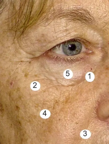 تغییرات ناشی از افزایش سن در بخش میانی صورت