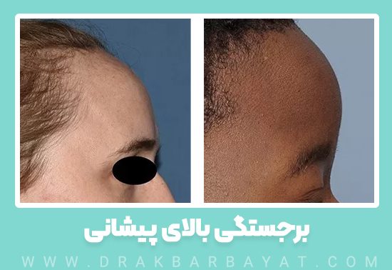 دو نمونه برجستگی بالای پیشانی که میتواند با افزایش طول پیشانی همراه باشد