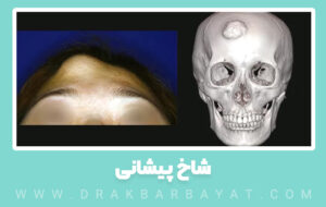 توده استخوانی پیشانی (استئوما)