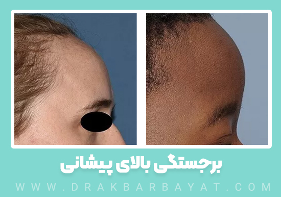 برجستگی بالای پیشانی