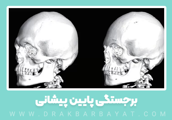 برجستگی پایین پیشانی