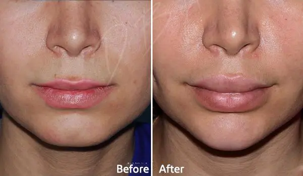 جراحی لب در تهران👄 |هزینه 1404+ نمونه کار | دکتر اکبر بیات