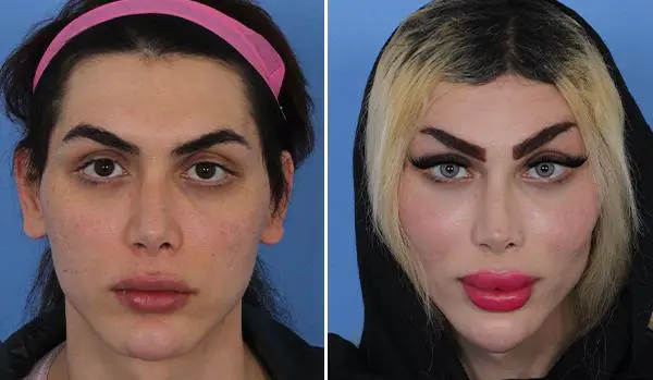 عکس عمل زیبایی کل صورت