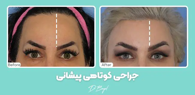 جراحی کوتاه کردن پیشانی